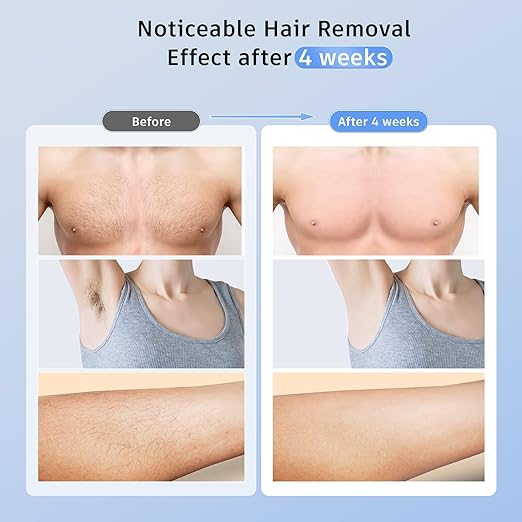Laser Hair Removal with 5℃ Ice Cooling